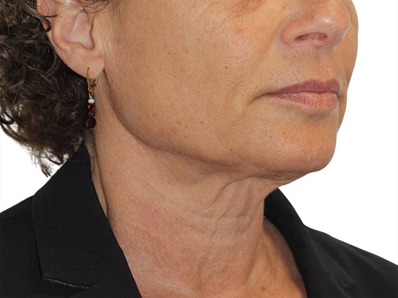 Sofwave Before & After Gallery - Patient 414496 - Image 1