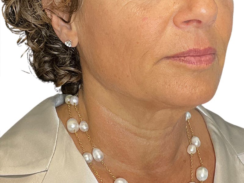 Sofwave Before & After Gallery - Patient 414496 - Image 2