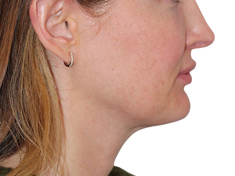 Sofwave Before & After Gallery - Patient 244943 - Image 1