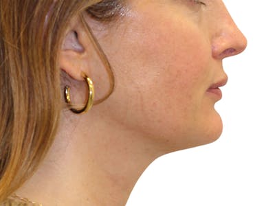 Sofwave Before & After Gallery - Patient 244943 - Image 2