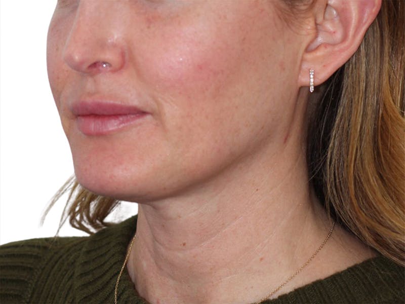 Sofwave Before & After Gallery - Patient 244943 - Image 3