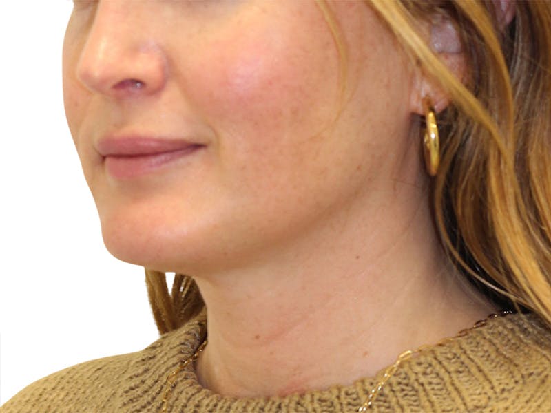 Sofwave Before & After Gallery - Patient 244943 - Image 4