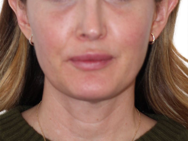 Sofwave Before & After Gallery - Patient 244943 - Image 5