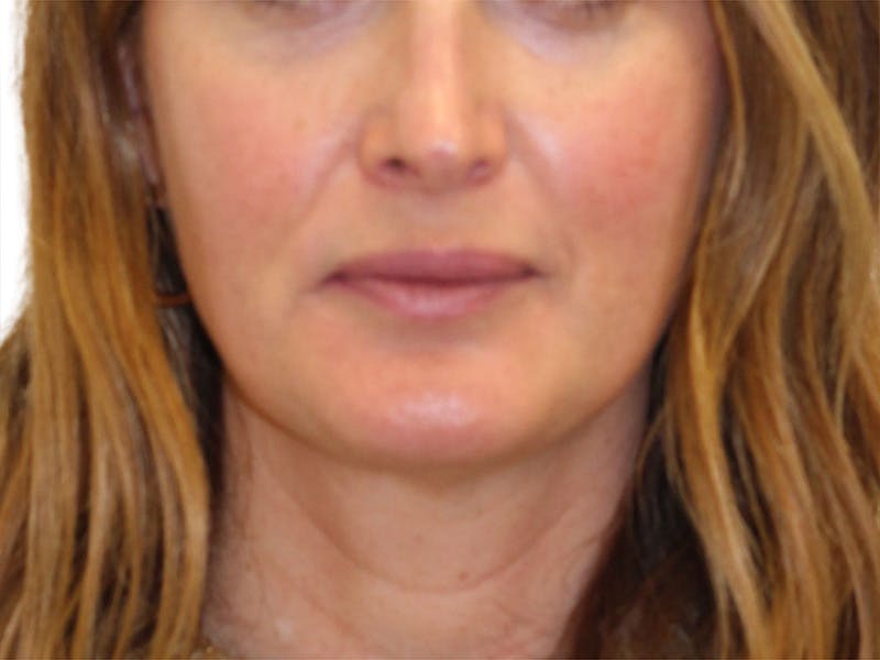 Sofwave Before & After Gallery - Patient 244943 - Image 6