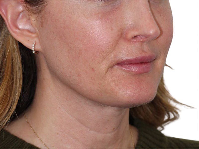 Sofwave Before & After Gallery - Patient 244943 - Image 7