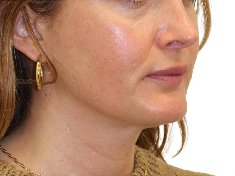 Sofwave Before & After Gallery - Patient 244943 - Image 8