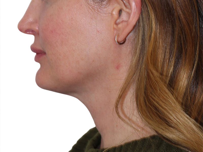 Sofwave Before & After Gallery - Patient 244943 - Image 9