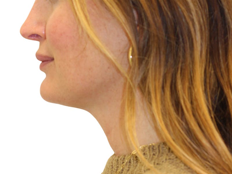 Sofwave Before & After Gallery - Patient 244943 - Image 10