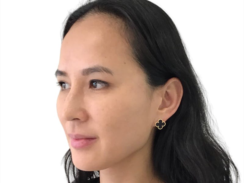 Sofwave Before & After Gallery - Patient 292364 - Image 1