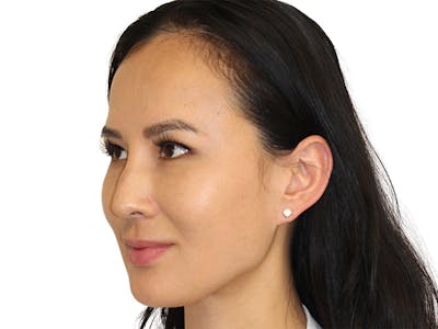 Sofwave Before & After Gallery - Patient 292364 - Image 2