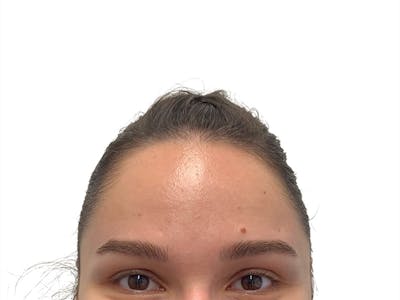 Sofwave Before & After Gallery - Patient 178292 - Image 1