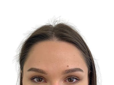 Sofwave Before & After Gallery - Patient 178292 - Image 2