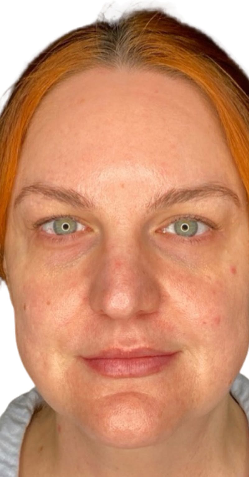 Skin Transformation Before & After Gallery - Patient 807669 - Image 1