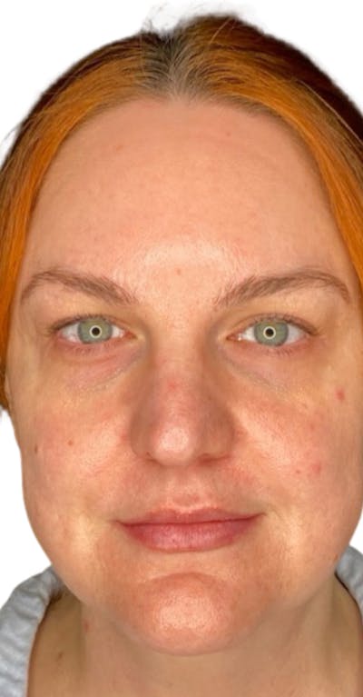 Skin Transformation Before & After Gallery - Patient 807669 - Image 1