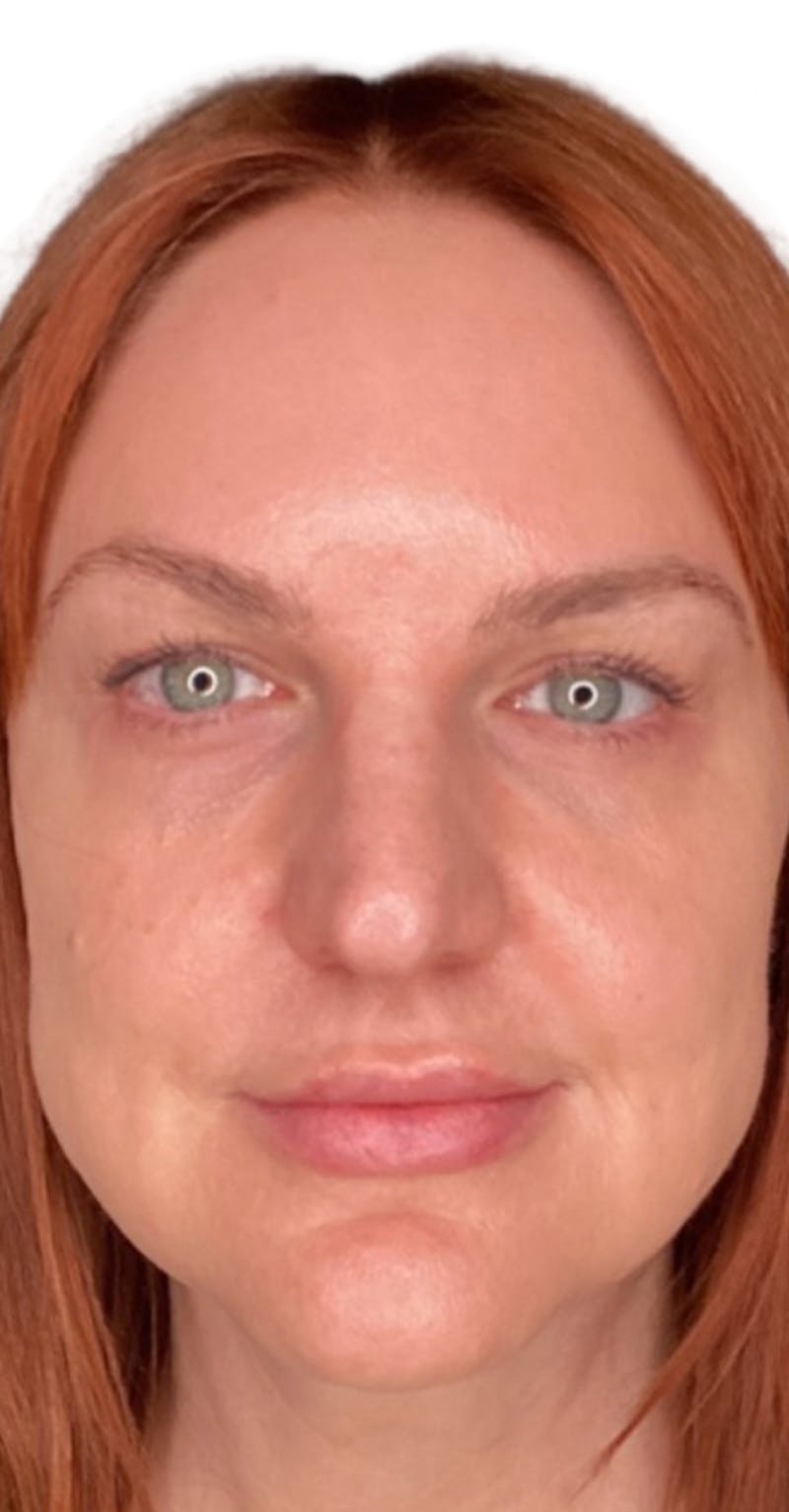 Skin Transformation Before & After Gallery - Patient 807669 - Image 2