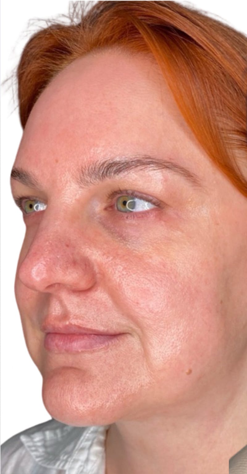 Skin Transformation Before & After Gallery - Patient 807669 - Image 3