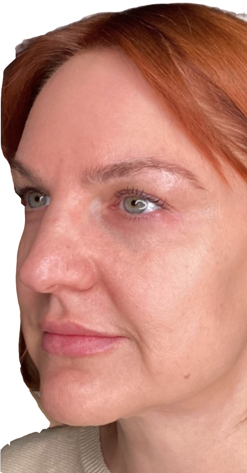 Skin Transformation Before & After Gallery - Patient 807669 - Image 4