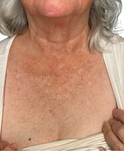 Skin Transformation Before & After Gallery - Patient 942519 - Image 1