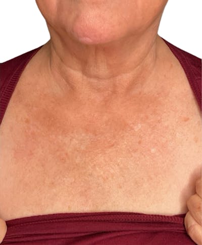 Skin Transformation Before & After Gallery - Patient 942519 - Image 2
