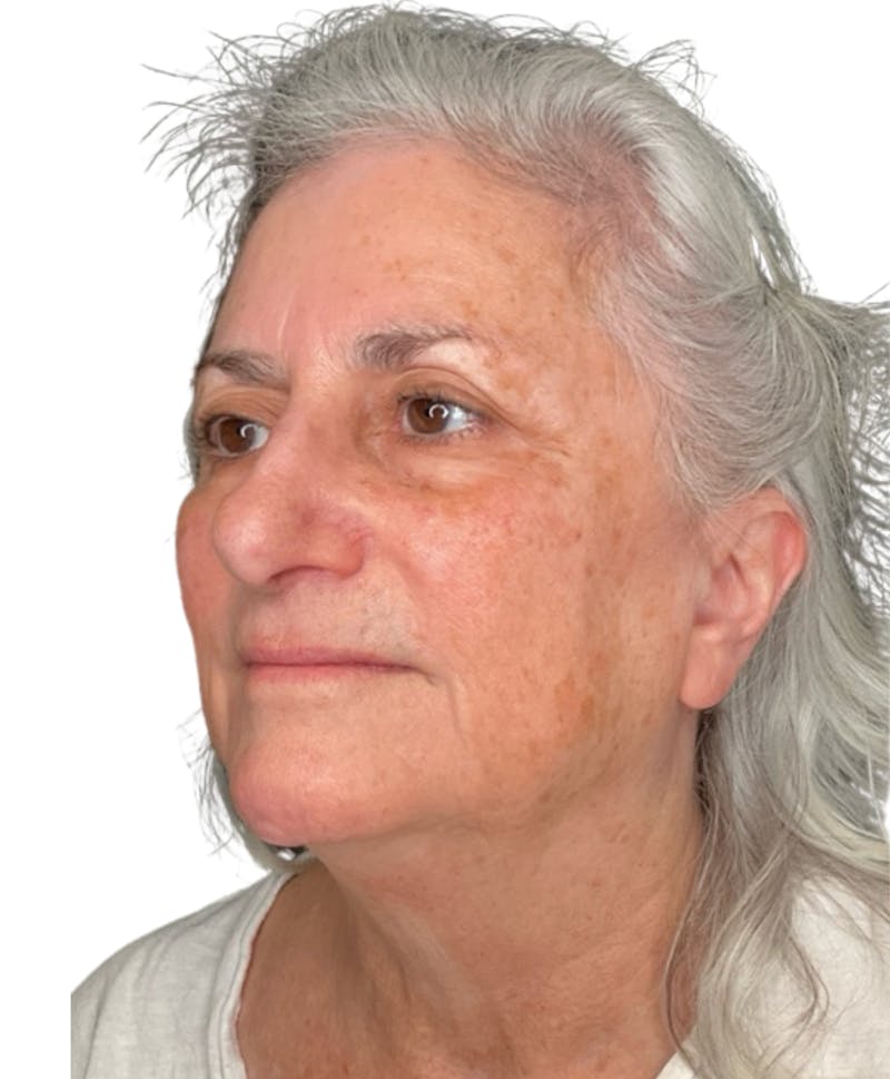 Skin Transformation Before & After Gallery - Patient 942519 - Image 3