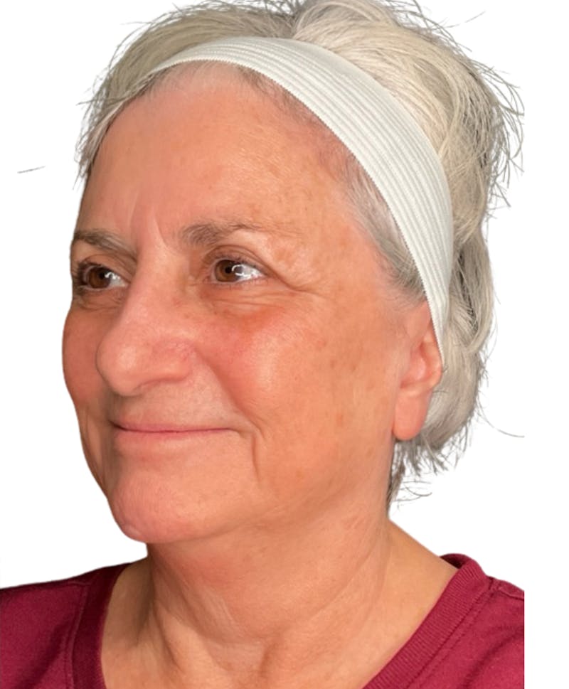 Skin Transformation Before & After Gallery - Patient 942519 - Image 4