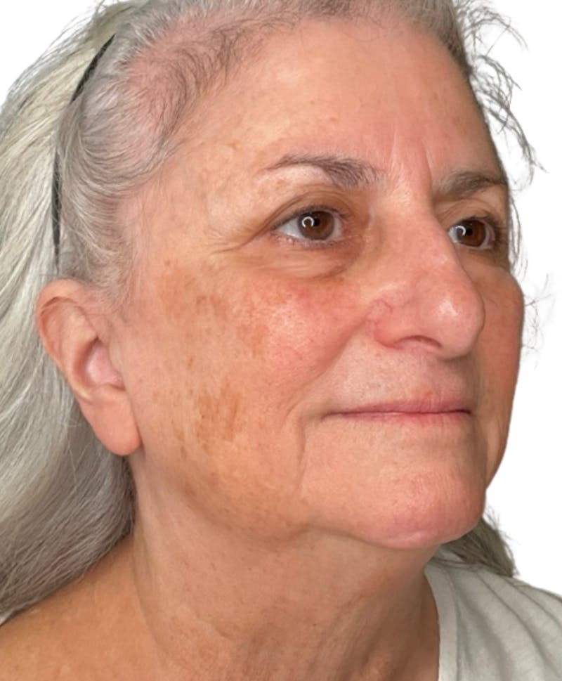 Skin Transformation Before & After Gallery - Patient 942519 - Image 5