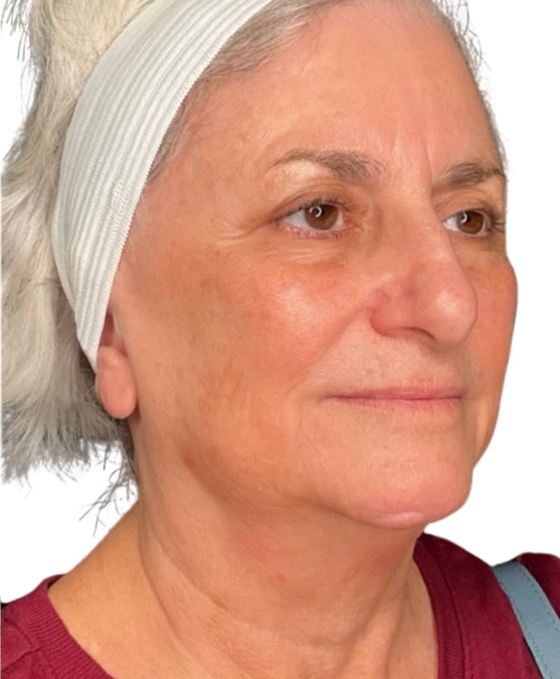 Skin Transformation Before & After Gallery - Patient 942519 - Image 6