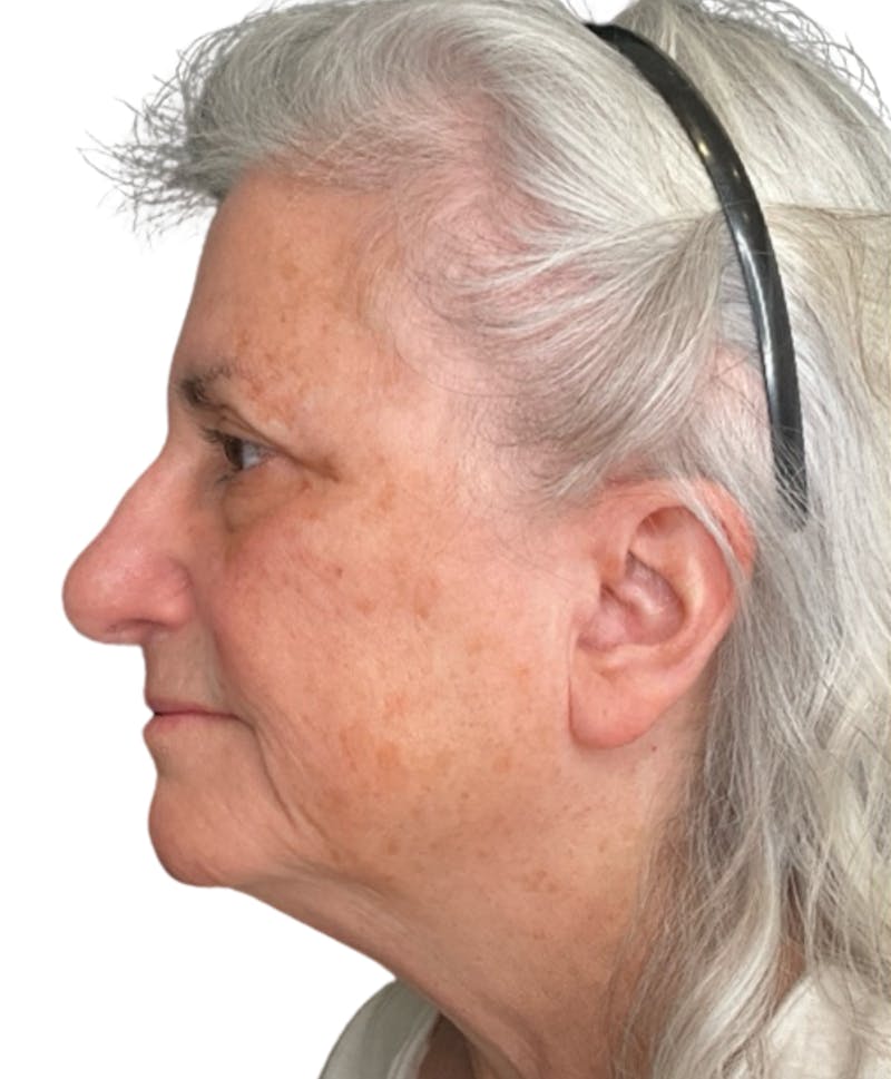 Skin Transformation Before & After Gallery - Patient 942519 - Image 7