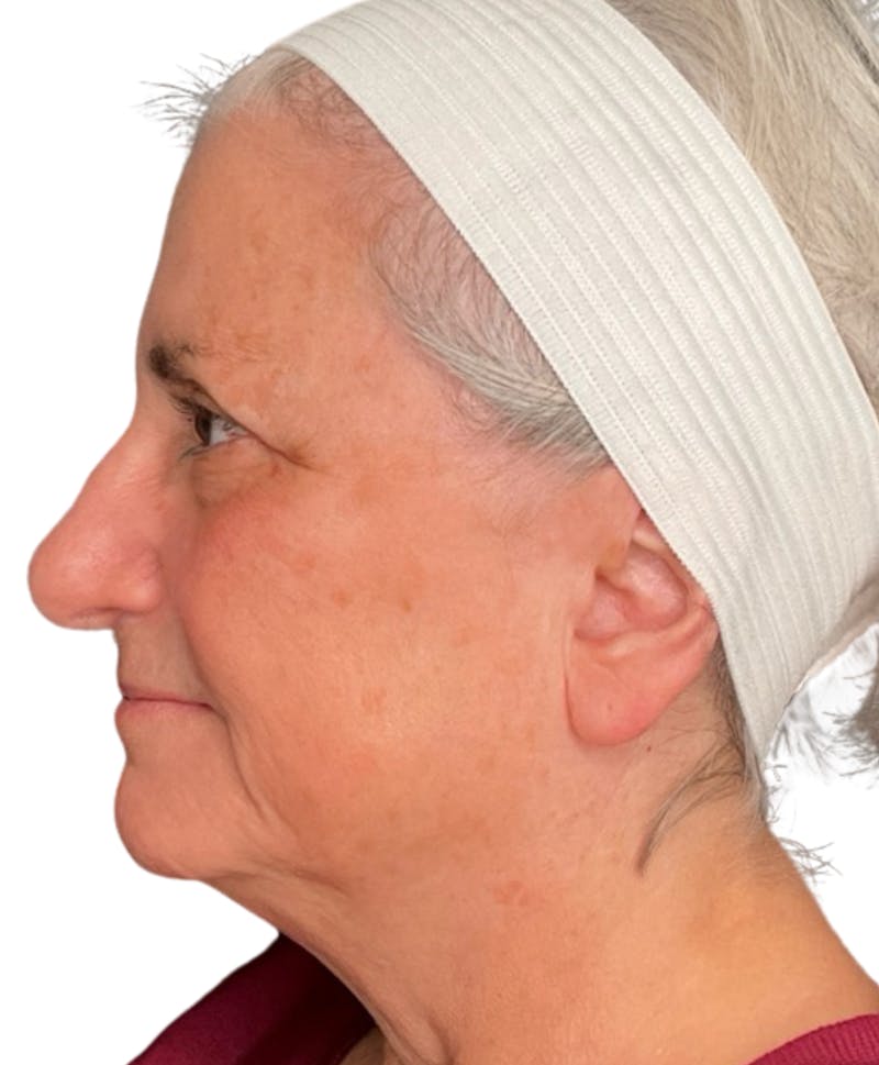 Skin Transformation Before & After Gallery - Patient 942519 - Image 8