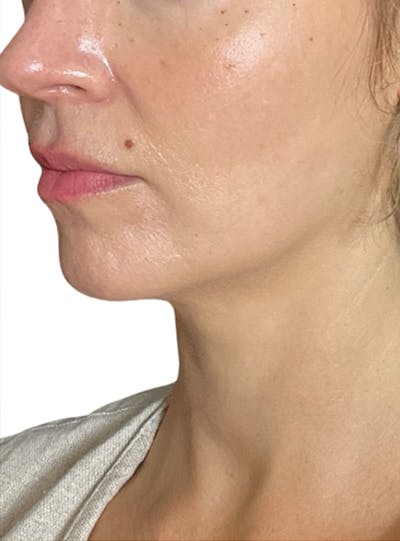 Skin Transformation Before & After Gallery - Patient 103688 - Image 1
