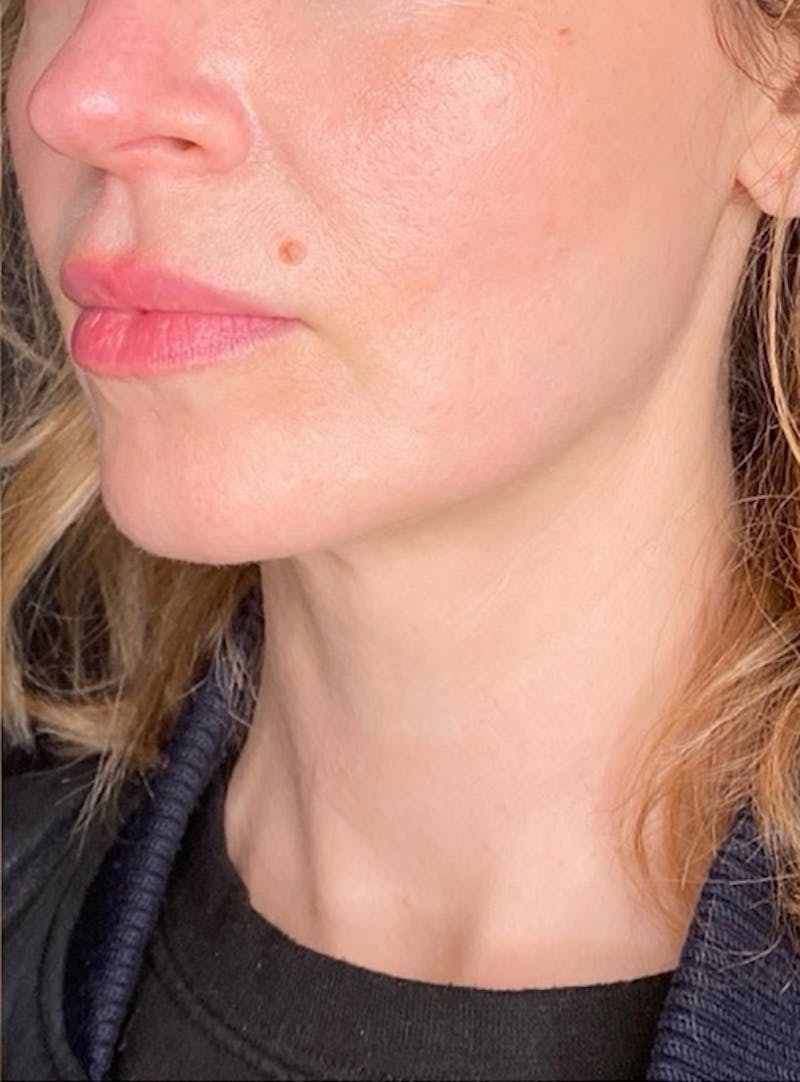 Skin Transformation Before & After Gallery - Patient 103688 - Image 2