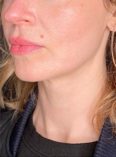 Skin Transformation Before & After Gallery - Patient 103688 - Image 2