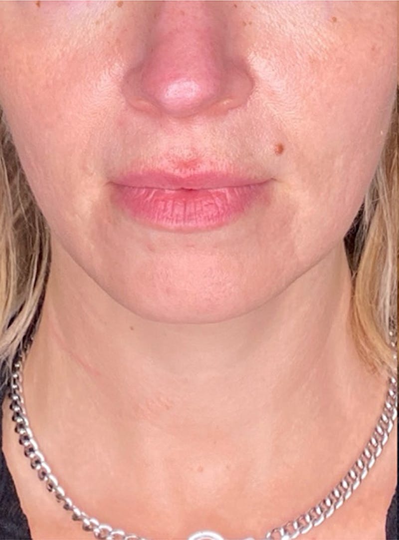 Skin Transformation Before & After Gallery - Patient 103688 - Image 3