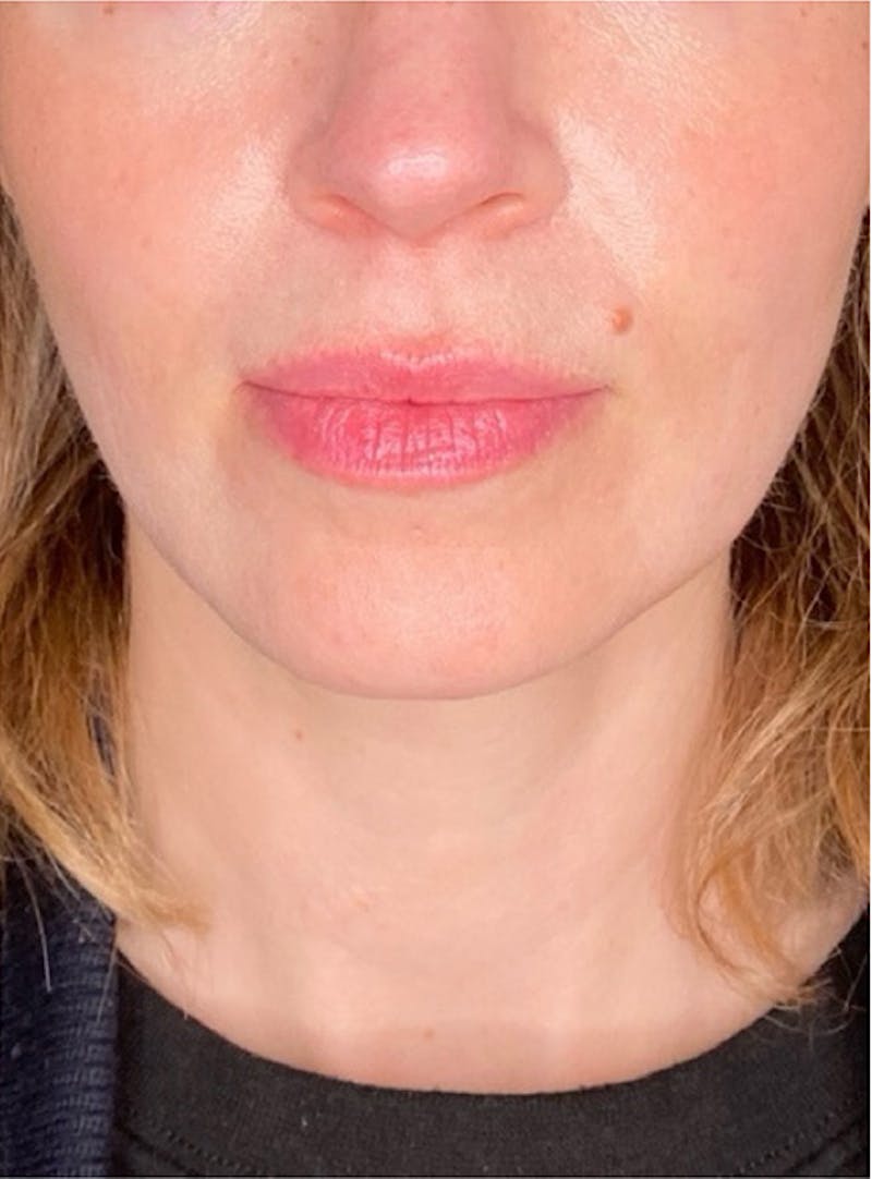 Skin Transformation Before & After Gallery - Patient 103688 - Image 4