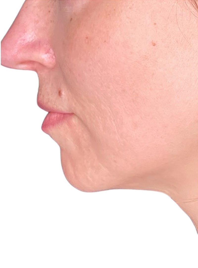 Skin Transformation Before & After Gallery - Patient 103688 - Image 5