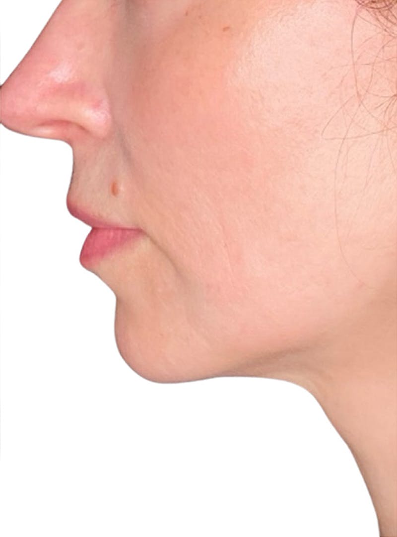 Skin Transformation Before & After Gallery - Patient 103688 - Image 6