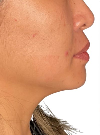 Skin Transformation Before & After Gallery - Patient 266251 - Image 1