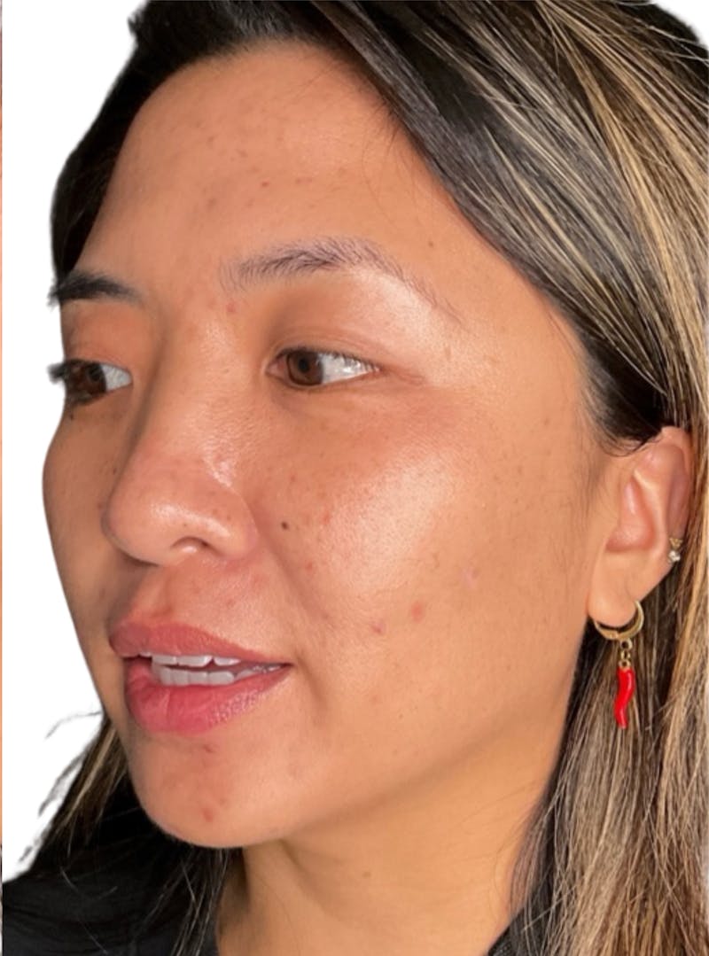 Skin Transformation Before & After Gallery - Patient 266251 - Image 3