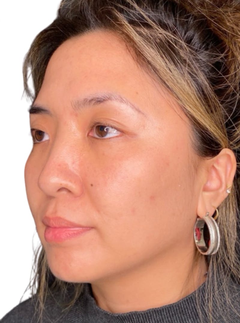 Skin Transformation Before & After Gallery - Patient 266251 - Image 4