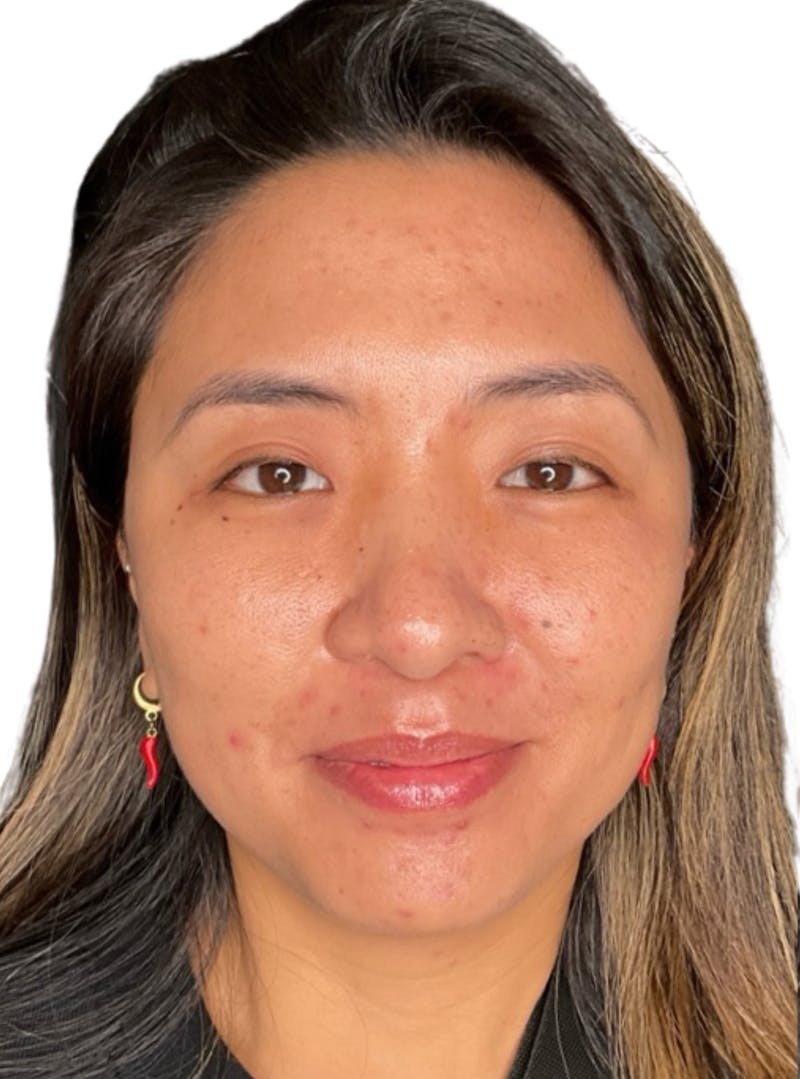 Skin Transformation Before & After Gallery - Patient 266251 - Image 5