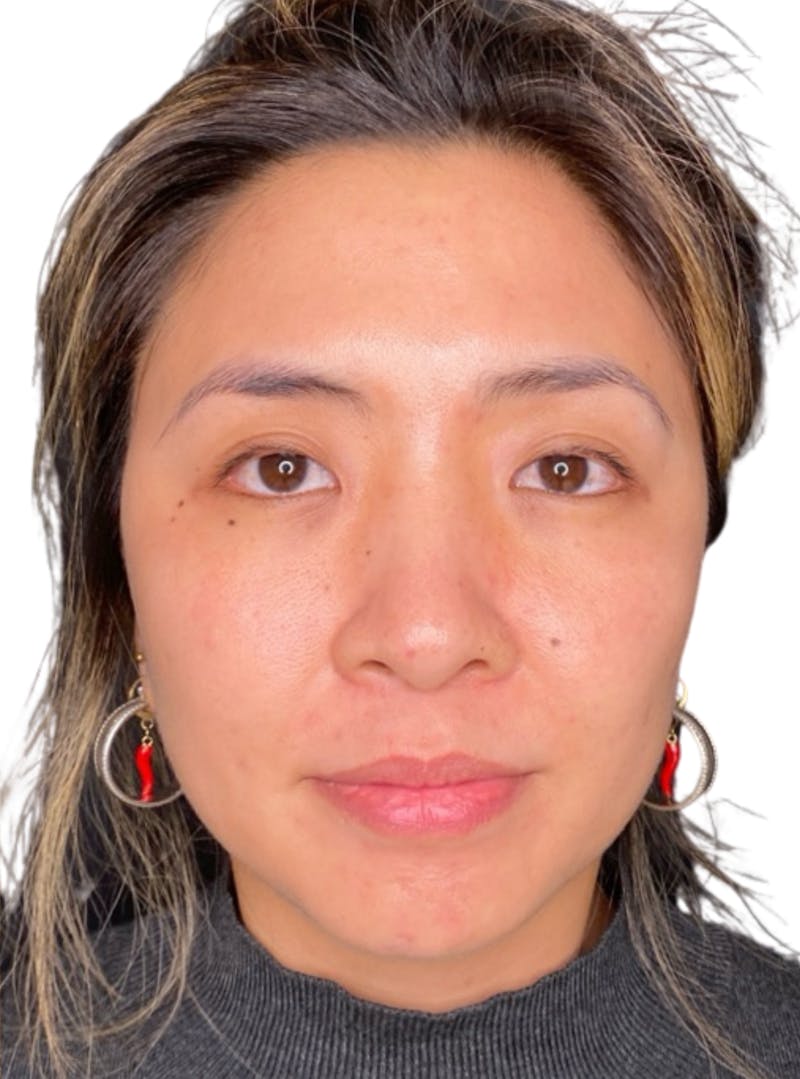 Skin Transformation Before & After Gallery - Patient 266251 - Image 6