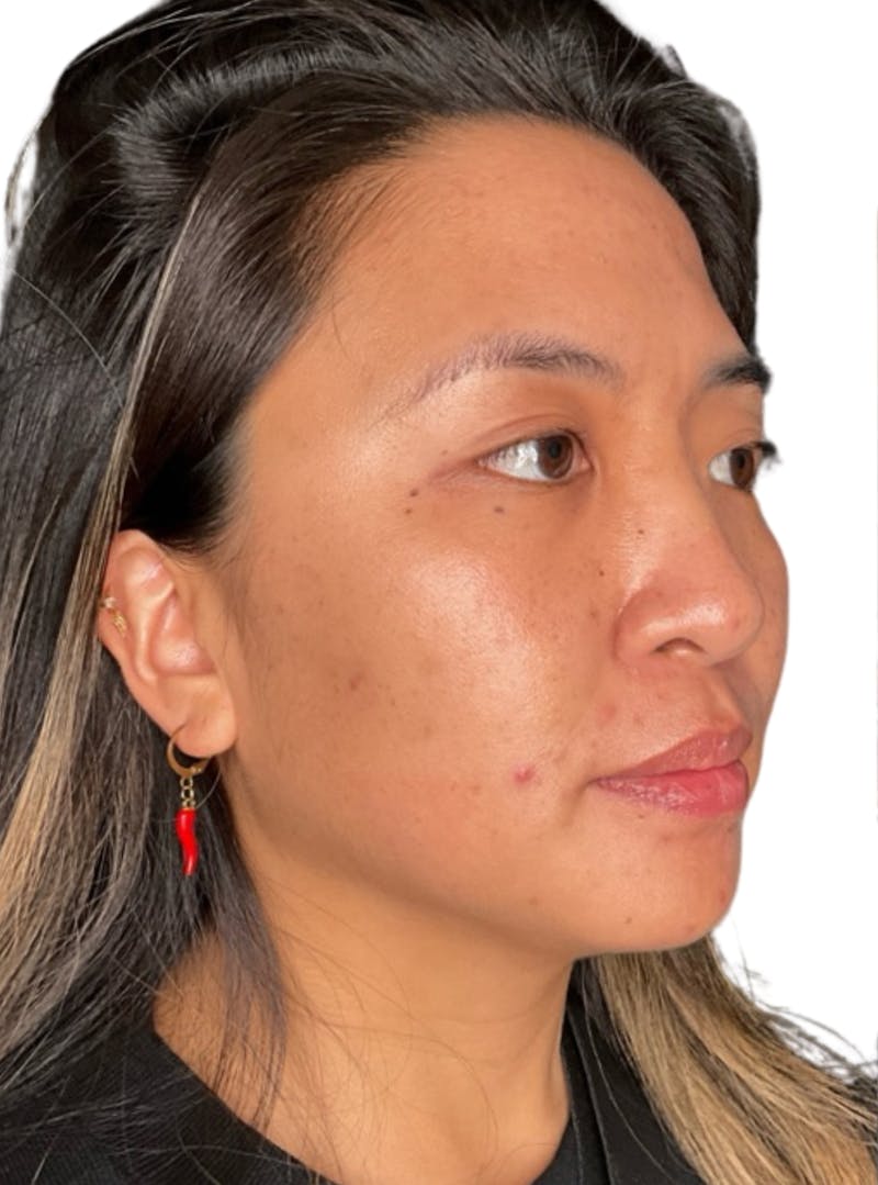 Skin Transformation Before & After Gallery - Patient 266251 - Image 7