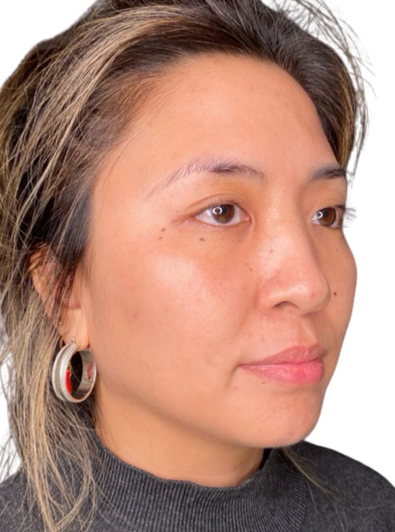 Skin Transformation Before & After Gallery - Patient 266251 - Image 8