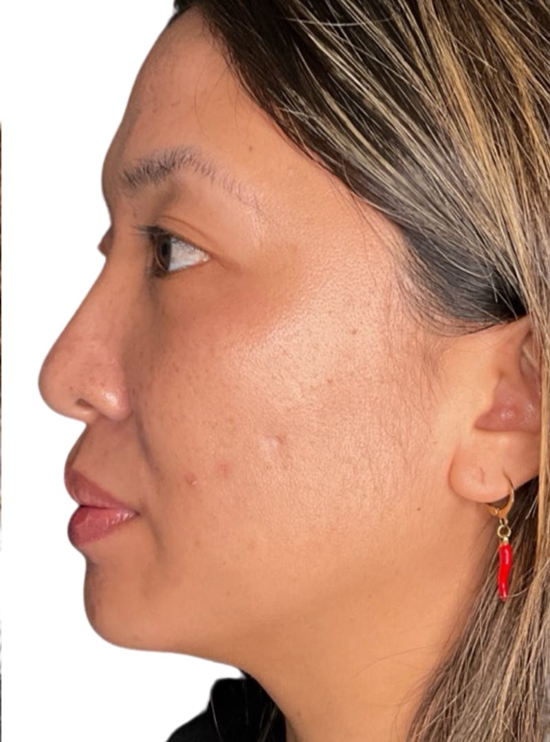 Skin Transformation Before & After Gallery - Patient 266251 - Image 9