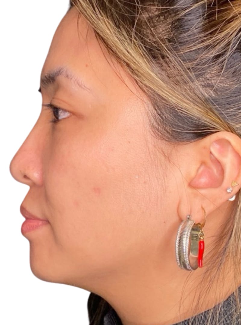 Skin Transformation Before & After Gallery - Patient 266251 - Image 10