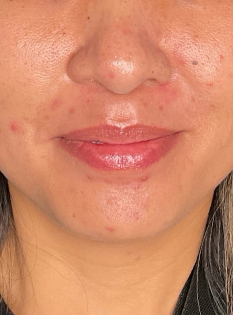 Skin Transformation Before & After Gallery - Patient 266251 - Image 11