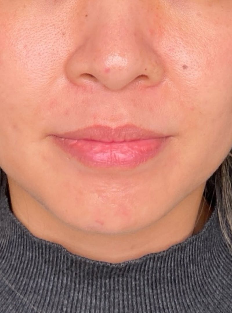 Skin Transformation Before & After Gallery - Patient 266251 - Image 12