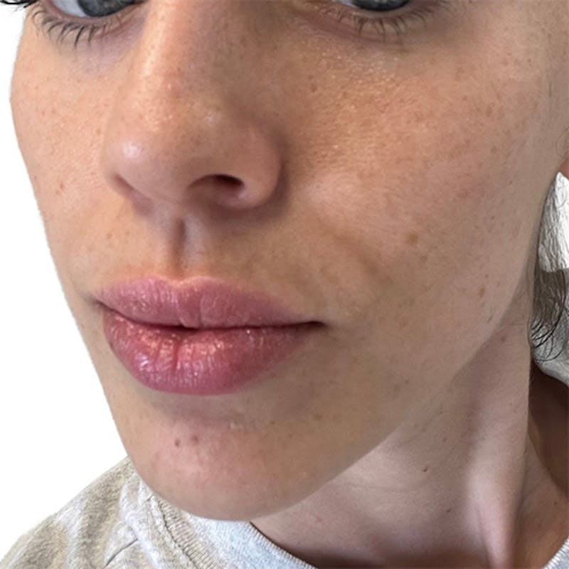 Skin Transformation Before & After Gallery - Patient 104535 - Image 1