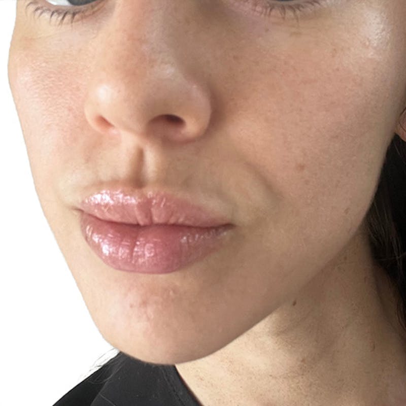 Skin Transformation Before & After Gallery - Patient 104535 - Image 2