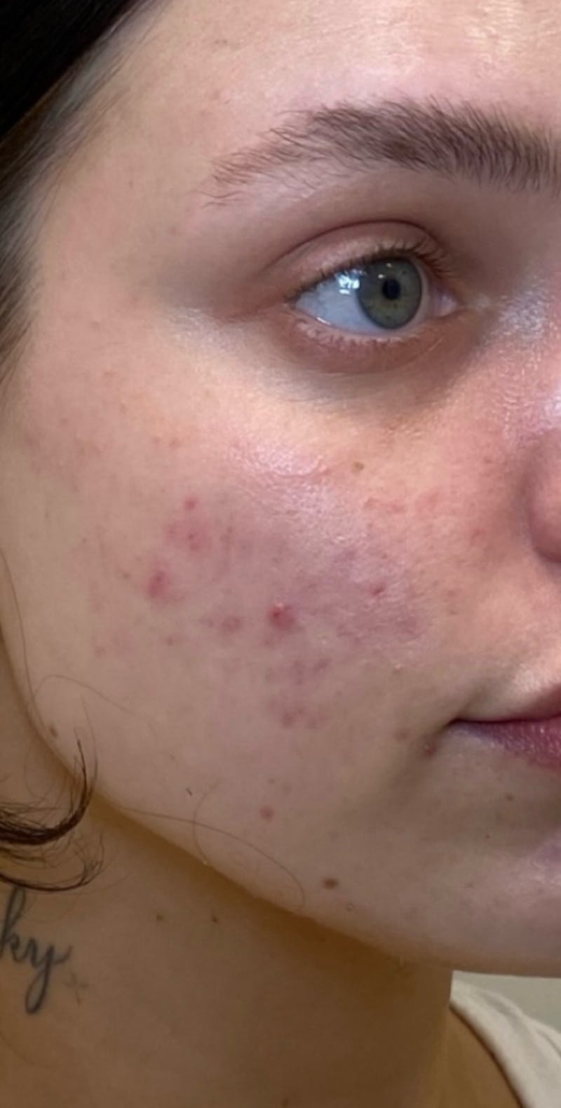 Skin Transformation Before & After Gallery - Patient 262728 - Image 1